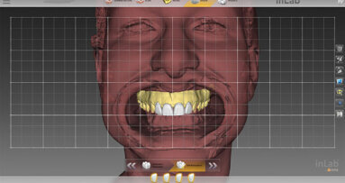 Highly esthetic results with CEREC® Primemill