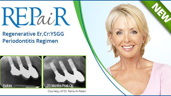 Láser contra la periodontitis