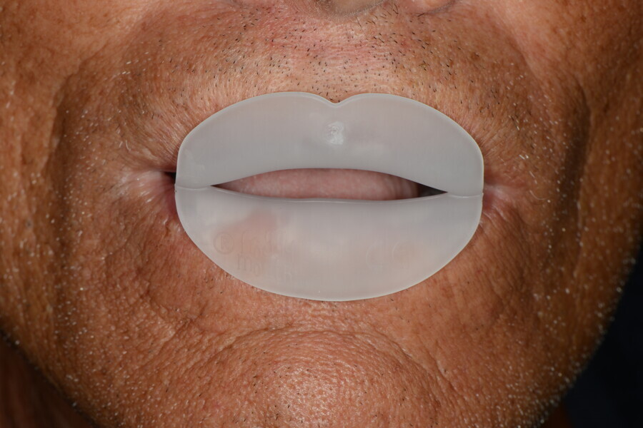 Fig. 16: Tongue dysfunction therapy with Froggymouth.