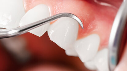 IQWiG: Systematische Behandlung von Parodontopathien IQWiG: Systematische Behandlung von Parodontopathien