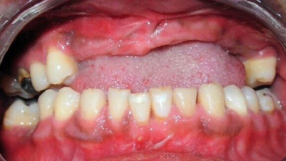 Future: Loose a tooth, grow a tooth with stem cells