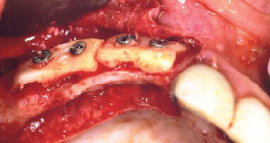 Horizontální augmentace kosti