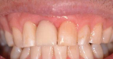 “One miracle at a time” – an implant case report