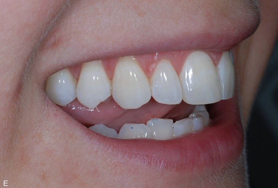 Fig. 18: Post treatment right lateral open bite