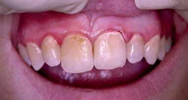 Leczenie parodontozy z większą mocą