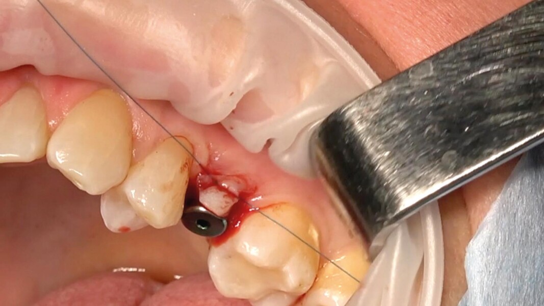Fig. 4_Sutura roll-flap.