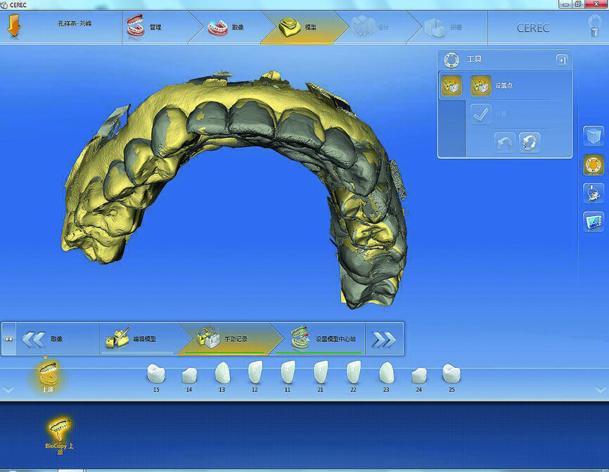 Fig. 15: Biocopy optic model accurately match with pre-operation model.