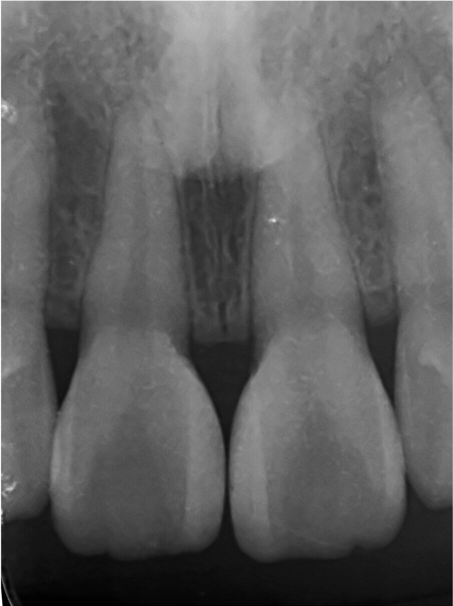 Fig. 5: Perfect emergency profile with front-wing technique. Courtesy of Dr. Jun Iwata, Japan.