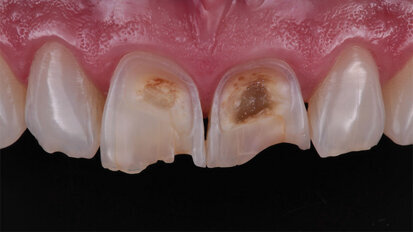 Solving aesthetic issues in the anterior  region with composite – Clinical Case