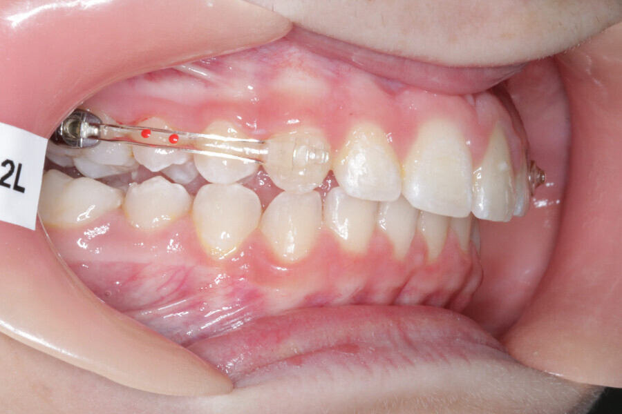 Fig. 9: Placement of the Carriere Motion 3D Clear Class II appliance.