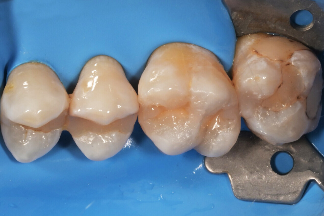 Фиг. 12: Обтурацията след наартикулиране и полиране. 