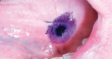 Oral cancer: il 47% dei casi diagnosticati tardivamente, perché?