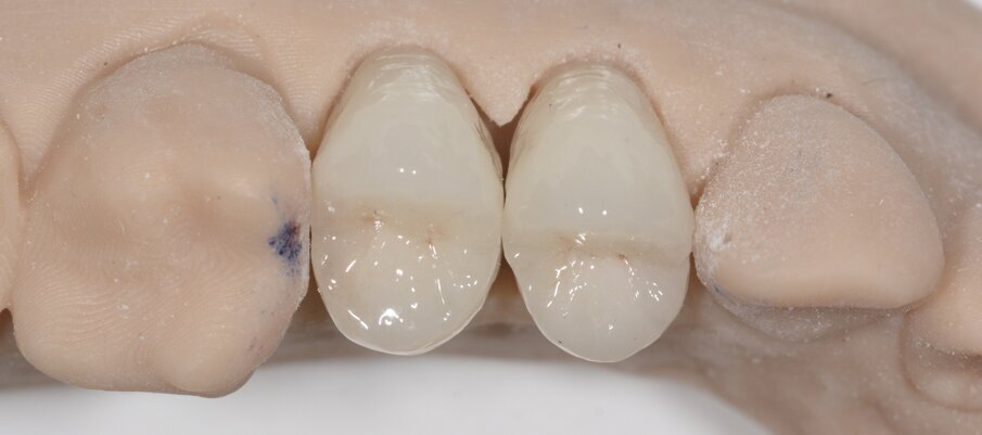 Fig. 5: Corone in zirconia dopo la glasatura sui modelli stampati.