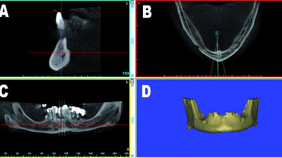 3-D virtual planning concepts for implant-retained full-arch mandibular prostheses: The bone reduction guide