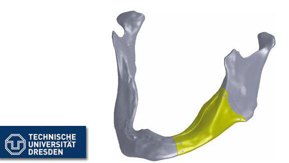 Erstes individuelles Unterkieferimplantat entwickelt