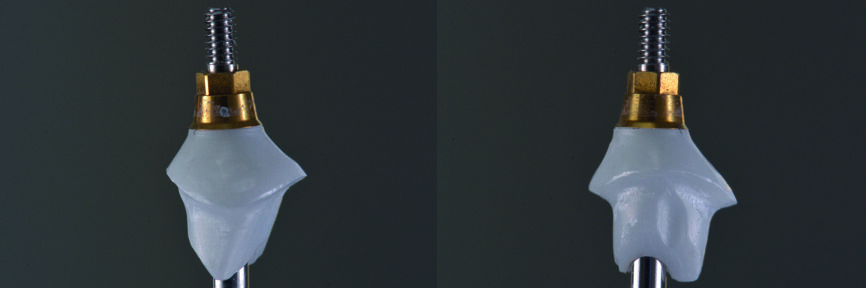 Fig. 29 : Piliers hybrides de GC (suprastructure en Zr sur base en Ti).