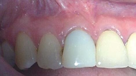 Rewizja leczenia endodontycznego po nieudanej resekcji wierzchołka korzenia