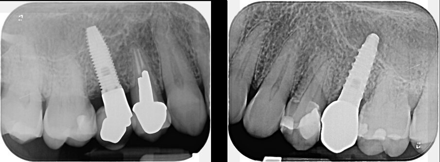 Fig. 3 - Condizione radiografica degli impianti 15 e 25 al baseline.