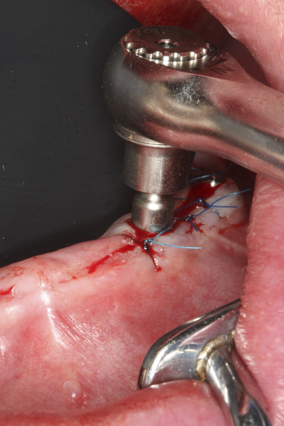 Fig. 8: The abutments were torqued to 25 Ncm.