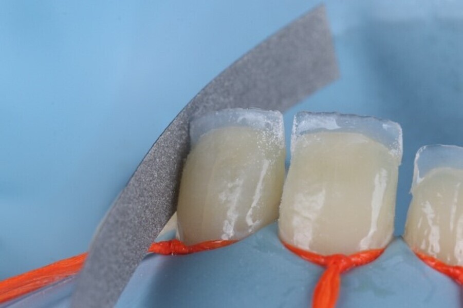 Fig. 3f: Shaping of the palatal shell using the diamond impregnated interproximal metal finishing strips.