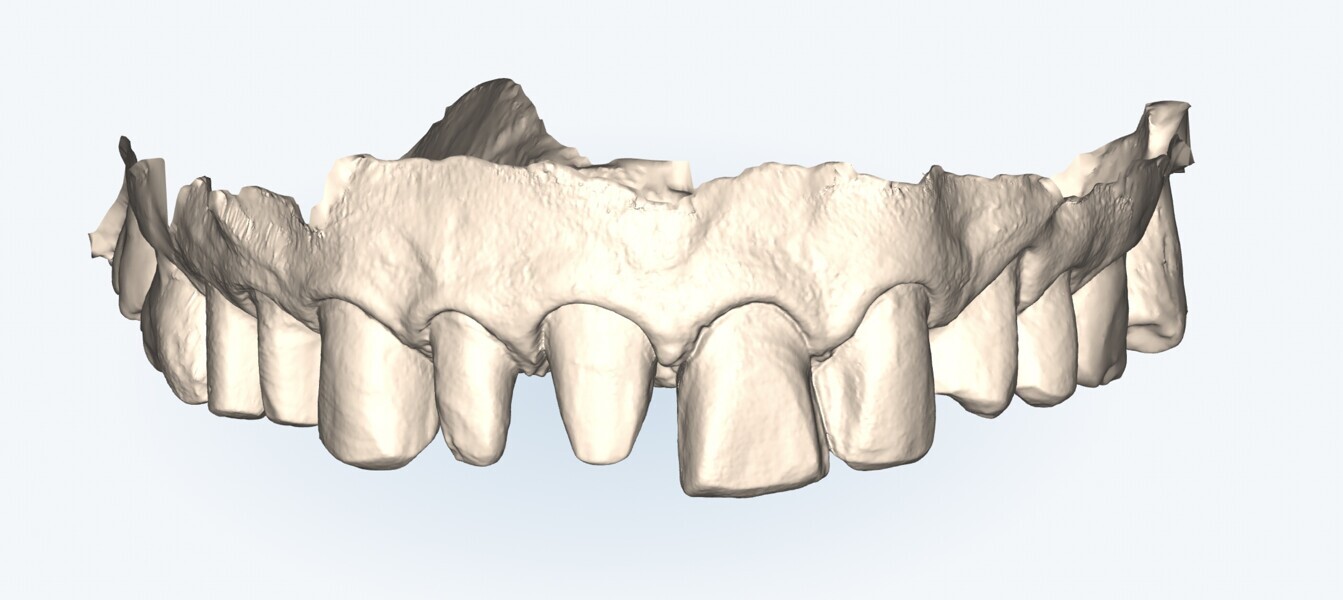 Fig. 18: Intra-oral scan with iTero.