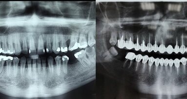 Da li postoji alternativa  sistemskoj antibiotskoj terapiji?