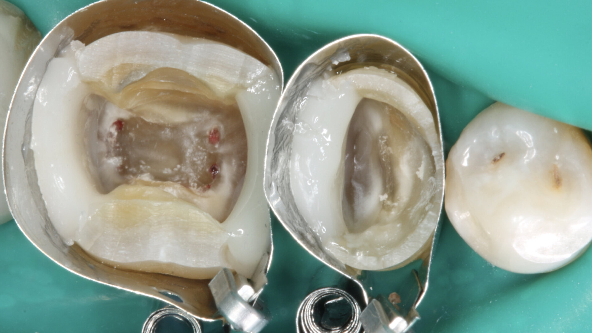 La cavité d’accès en endodontie : les trois principes pour un résultat prédictible dans les cas complexes