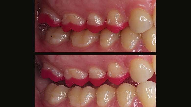 Figure 13: Examination of the static and dynamic occlusion with ReFu wax