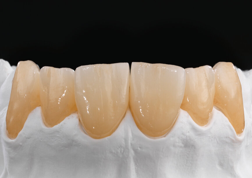 Zolid FX Multilayer, eine innovative Lösung, die 2016 eingeführt wurde, war der erste Rohling mit integrierten Farb- und Transluzenzgradienten. © Lucas Lammott/M31 Dental Studio