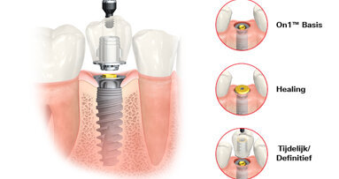 On1™ combineert het beste van twee werelden.