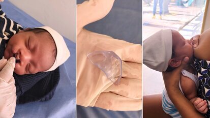 Rehabilitación de bebés con labio y paladar fisurado