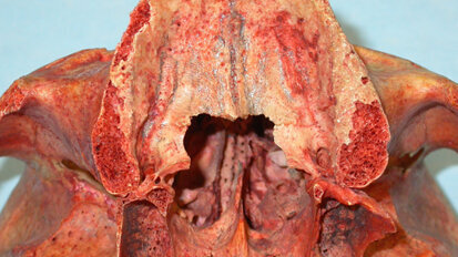 La regione palato-pterigo-tuberositaria: interesse chirurgico in implantologia