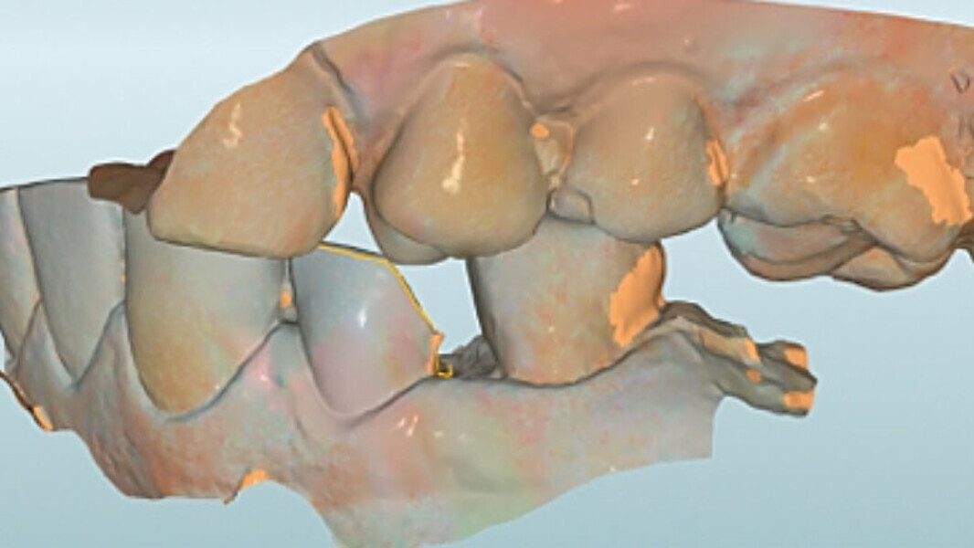 Fig. 6. Mediante un escaneo vestibular se trasladó la intercuspidación habitual.