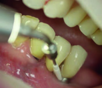 Fig. 12: Calculus removal on an implant with PI attachment by EMS. The tip enables cleaning of implant, implant post and crown surfaces without damaging titanium or zirconium surfaces.