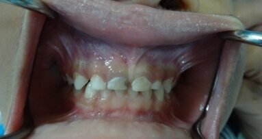 The “All Hall” case: Maximum capacity use of the Hall technique in a single child patient