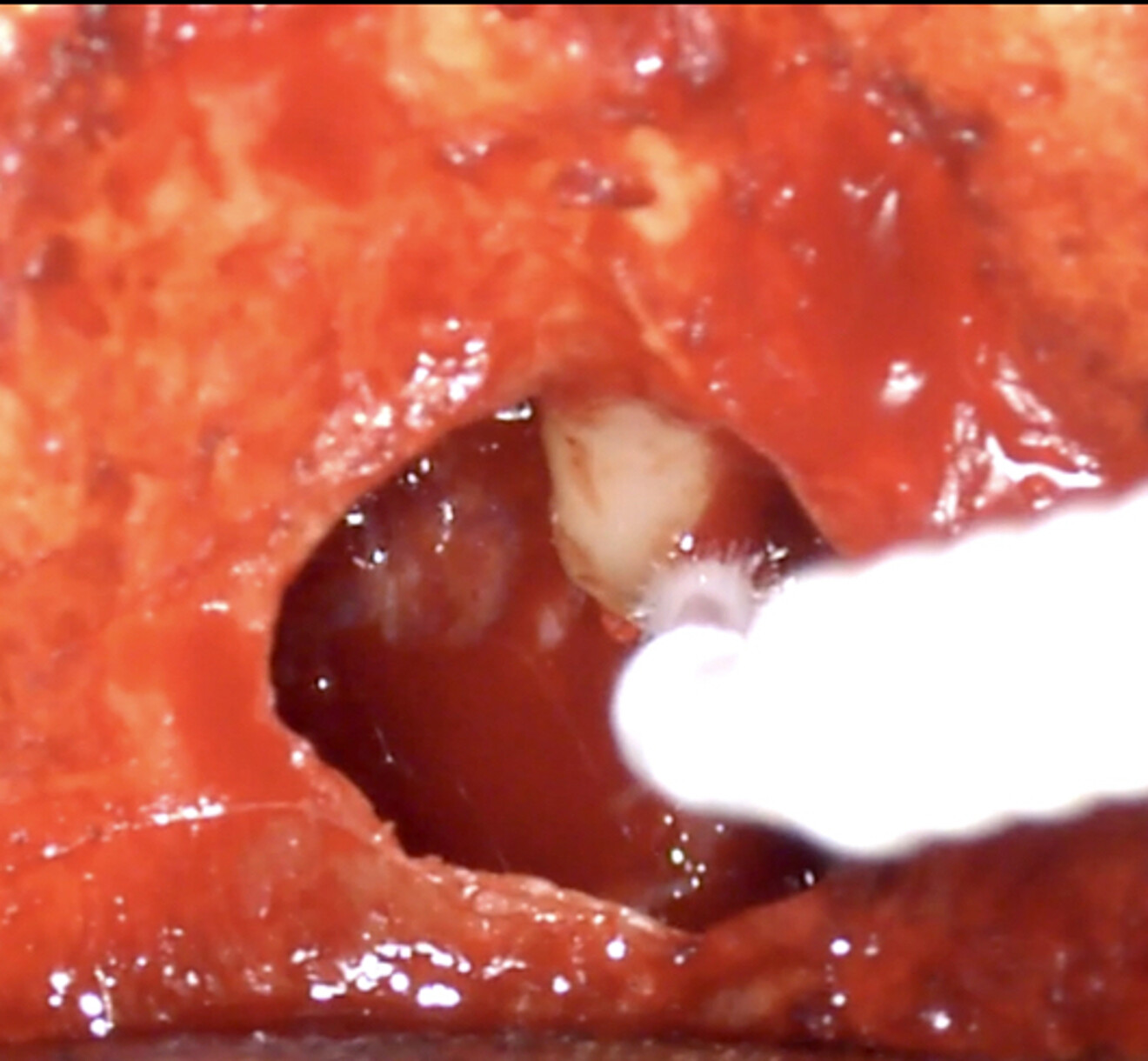 Fig. 4c: Removing the cyst from around the root without damaging the surface, followed by surface treatment of the exposed part of the root.