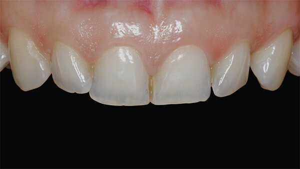 Fig. 1. Fotografía inicial de los dientes anteriores antes del tratamiento de ortodoncia.