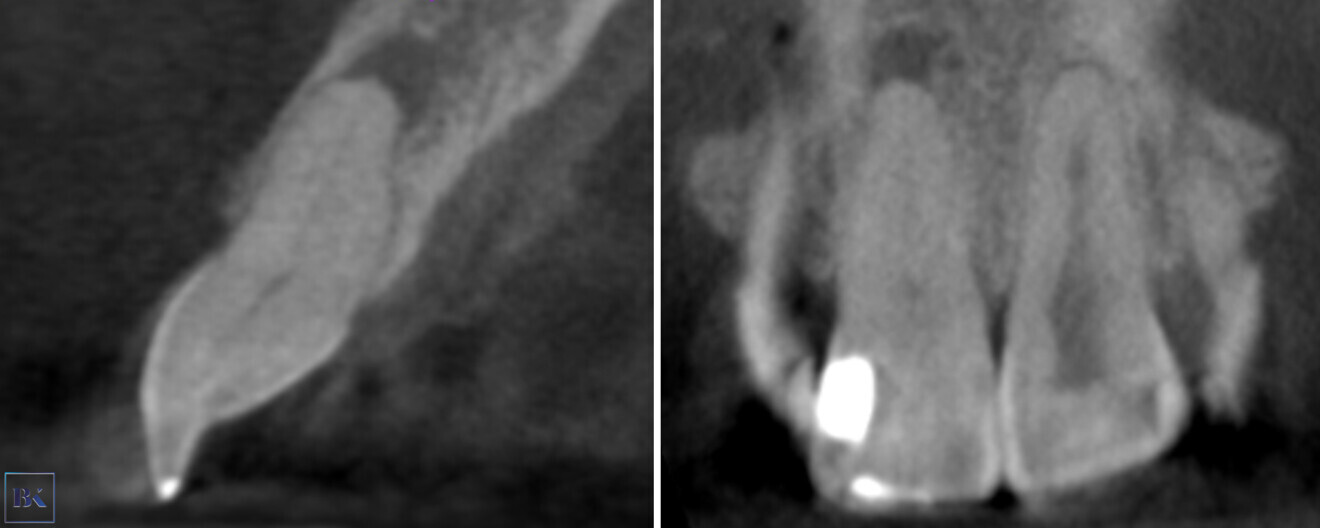Figs. 2a & b: CBCT scan, sagittal (a) and coronal planes (b). Visible pulp canal obliteration and periapical lesion.