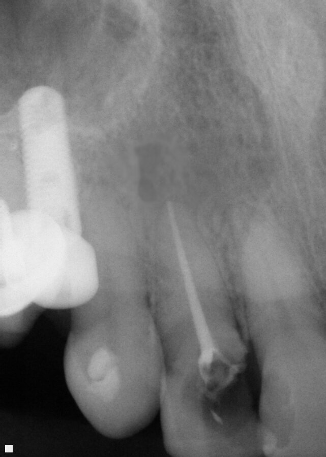 Fig. 12: Final obturation following instrumentation of tooth 7 with ExactTaperH DC files and resolution of the apical area utilizing Vitapex as an intracanal medicament between appointments.