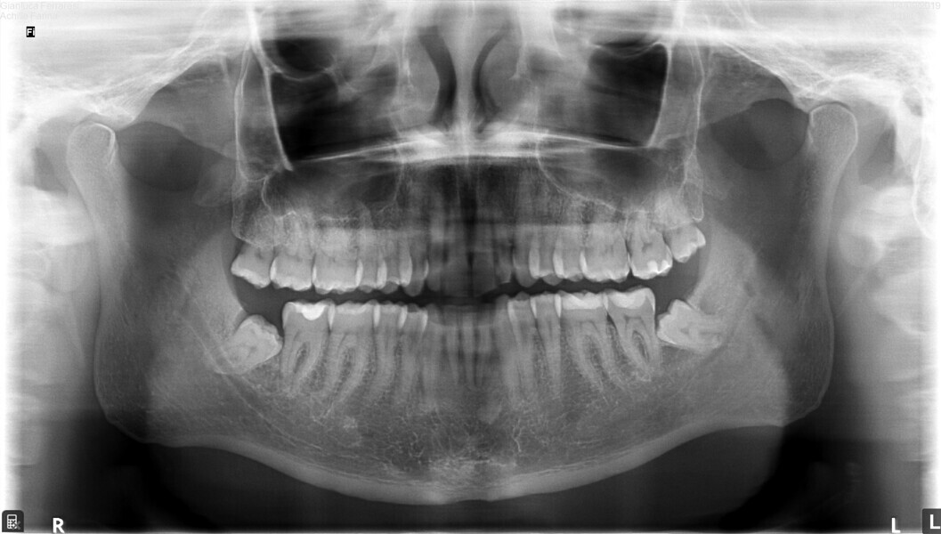 Fig. 60: Post-treatment panoramic radiograph.
