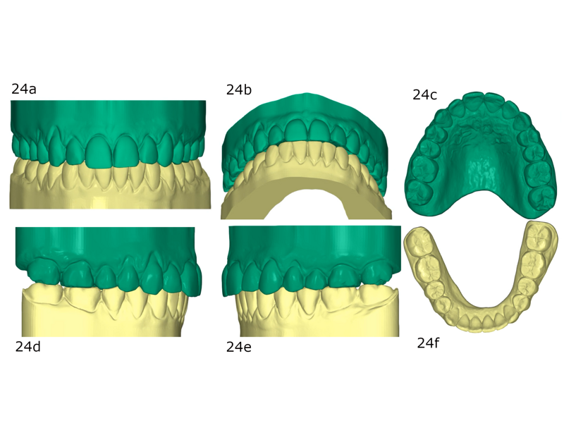 Figs. 24a–f: Post-treatment models.