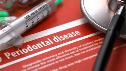 美研究人员发现牙周疾病与牙缺失和死亡率之间的关联