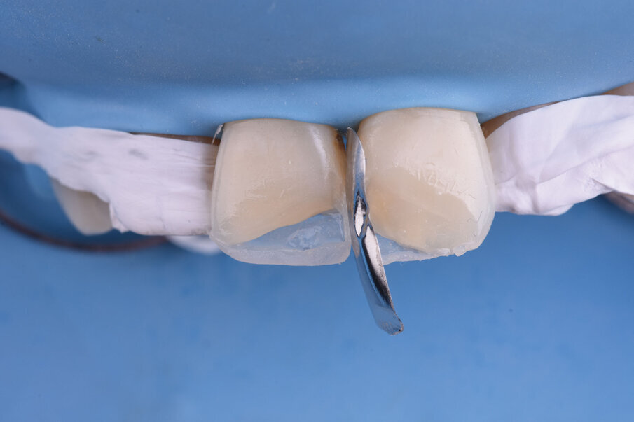 Sl. 9a: Modelovanje aproksimalnog zida restauracije