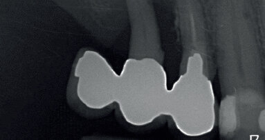 Il Biopad® come coadiuvante emostatico nei processi di guarigione dell’alveolo post-estrattivo