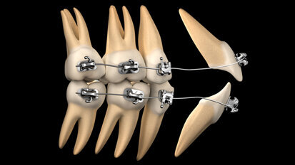 Přehled klinické ortodoncie: Mechanika léčby, část I.