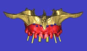 2-Ed_Testori_Implants