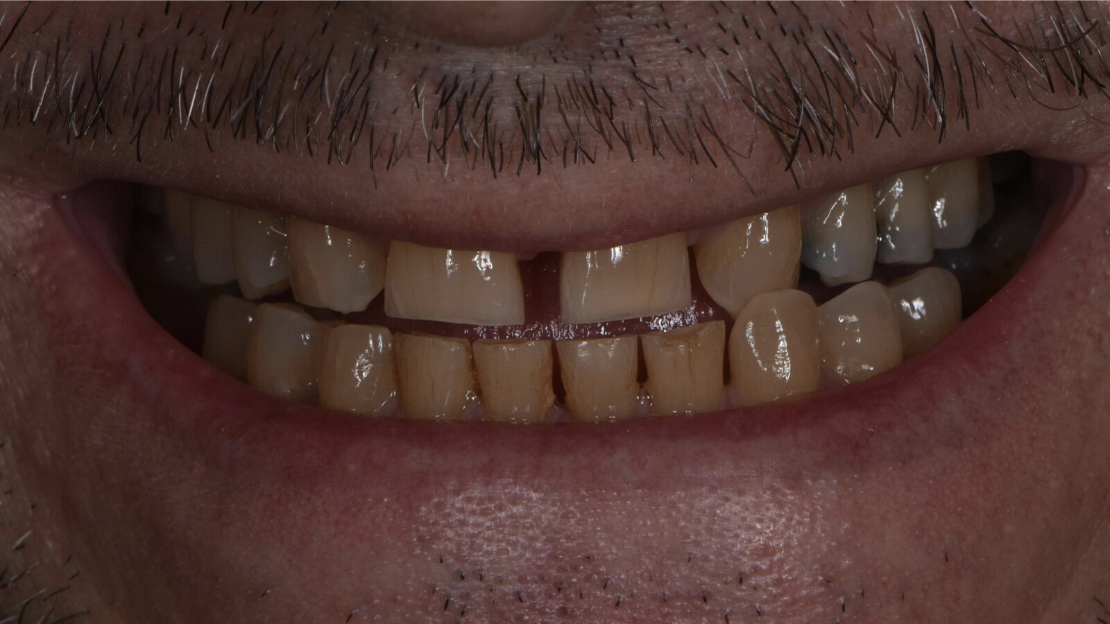 Revolutionising dental treatments: The power of digital integration with Invisalign Smile Architect