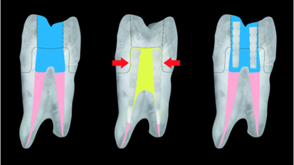 Rationale for the suggested use of fibre post segments in composite core build-ups for endodontically treated teeth