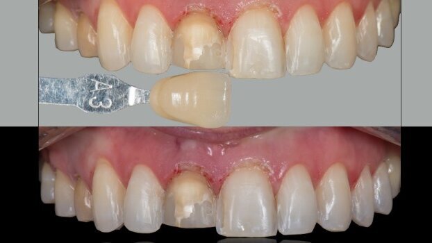 Estetyczne możliwości leczenia w ramach rehabilitacji okluzji – część 1