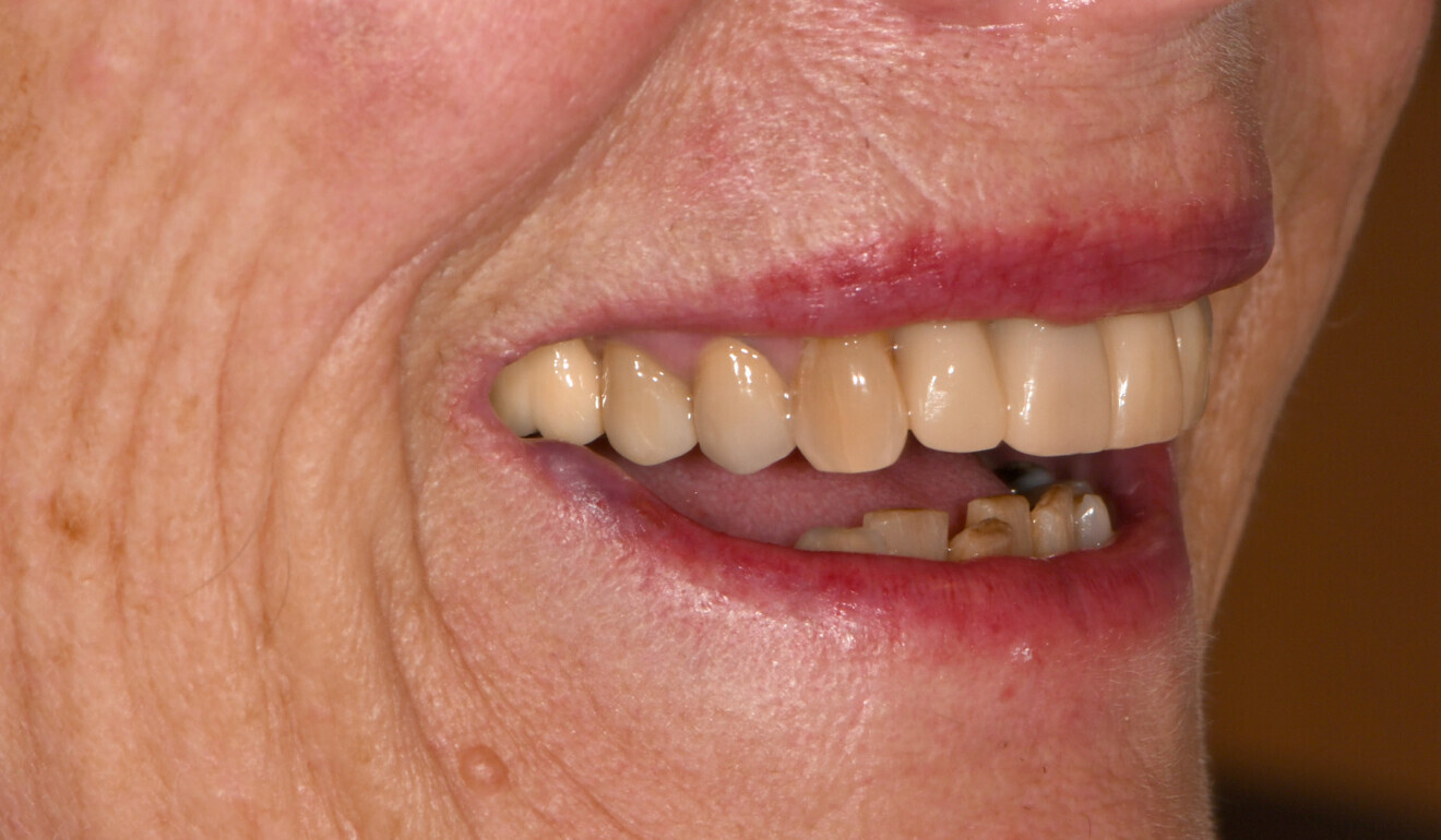 Fig. 8: Long-term temporary restorations in place, lateral view from the right.